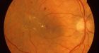 Kids' eyes offer earliest signs of heart disease